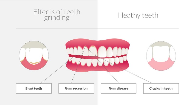 How To Stop Grinding My Teeth? - My Dentist Burbank