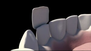 veneers